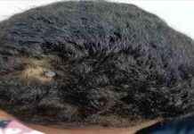 استخراج مسمار اخترق رأس طفل في الفيوم – العملية والصور