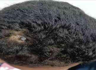 استخراج مسمار اخترق رأس طفل في الفيوم – العملية والصور