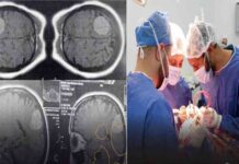 جراحة استئصال ورم بالمخ وتثبيت فقرات عنقية: نجاح عمليتين دقيقتين